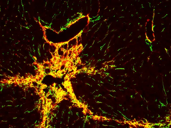 Leberfibrose bei einer Maus: Die Markierung von zwei charakteristischen Proteinen (gelb) verrät den krankhaften Umbau des Organs