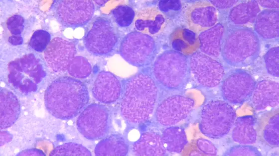 Bone marrow smear of acute myeloid leukemia. Alwin Krämer, German Cancer Research Center