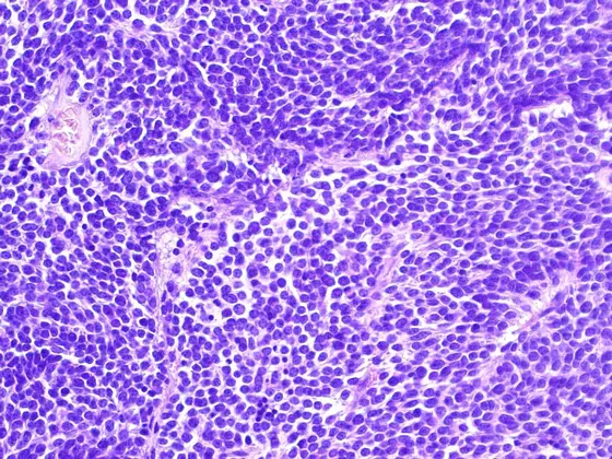 Diagnosis „primitive neuroectodermal tumor of the CNS": Tumor cells are small and poorly differentiated.