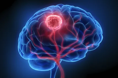 Eine computergenerierte Darstellung eines menschlichen Gehirns, das mit roten und blauen Adern dargestellt ist. Im Zentrum des Gehirns befindet sich ein roter Punkt, der einen Tumor symbolisiert, umgeben von einer leuchtenden Umgebung.