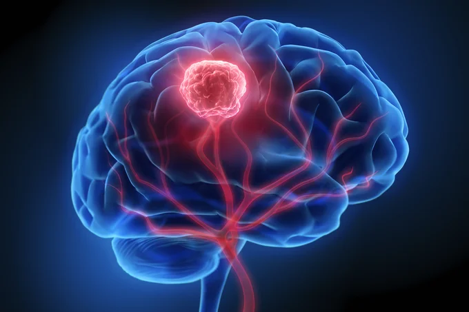 Eine computergenerierte Darstellung eines menschlichen Gehirns, das mit roten und blauen Adern dargestellt ist. Im Zentrum des Gehirns befindet sich ein roter Punkt, der einen Tumor symbolisiert, umgeben von einer leuchtenden Umgebung.
