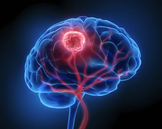 Eine computergenerierte Darstellung eines menschlichen Gehirns, das mit roten und blauen Adern dargestellt ist. Im Zentrum des Gehirns befindet sich ein roter Punkt, der einen Tumor symbolisiert, umgeben von einer leuchtenden Umgebung.