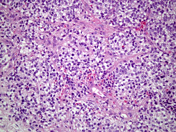 Ewing sarcoma cells are small, round and undifferentiated. Without using molecular analysis technologies, it is hard to differentiate them from other tumor cells, which often complicates and delays diagnosis.