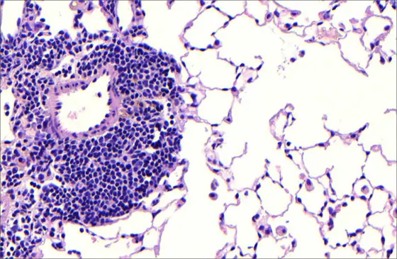 Gewebeschnitt durch die Lunge einer Maus, die über sechs Monate hinweg Zigarettenrauch ausgesetzt war. In den sich entwickelnden Follikel sind dicht gepackte Entzündungszellen zu erkennen, geschädigte Alveolarstrukturen vergrößern den Luftraum. Beides sind charakteristische Merkmale der COPD.