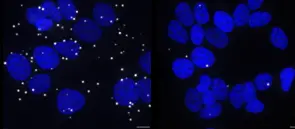 Die Abbildung zeigt die Assoziation (weiße Punkte) des Ankerproteins G3BP1 mit dem TSC-Komplex in Brustkrebszellen. Links: G3BP1 vorhanden, rechts, G3BP1 fehlt. Zellkerne in blau angefärbt.
