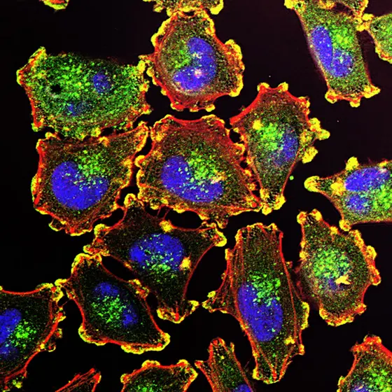 Metastasierende Melanomzellen