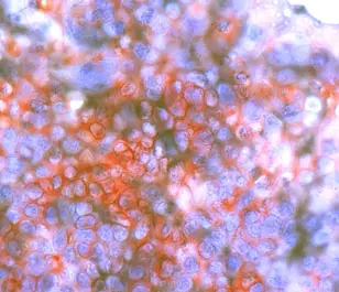 Microscopic section image of bone marrow of a breast cancer patient: Tumor-specific T cells (red) are activated by dendritic cells (black).