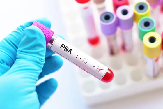 Eine Hand mit blauer Handschuh hält ein Röhrchen mit rotem Blut, auf dem "PSA" und ein Häkchen aufgedruckt sind. Im Hintergrund sind weitere Proberöhrchen in verschiedenen Farben sichtbar.