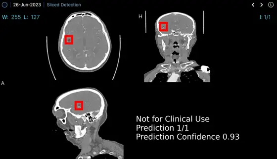 Neue KI-Anwendung im Einsatz: Das Analyseprogramm prüft anhand von CT-Bildern, ob ein Gefäßverschluss vorliegt und wie sicher es sich in seiner Diagnose ist.