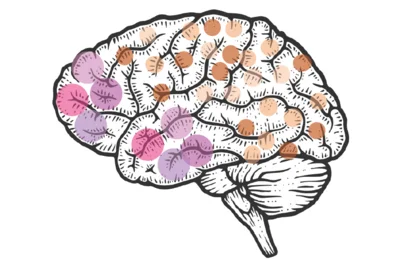Illustration of a human brain, showing various regions highlighted in different colors, including purple and orange. The image represents concepts related to brain research, particularly focusing on genetic mosaicism and its implications for tumor formation, as discussed in the surrounding text.