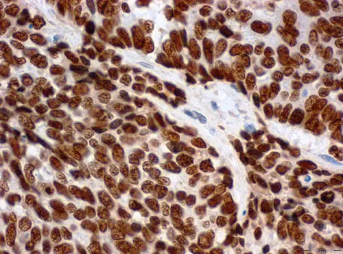 Querschnitt durch eine Gewebeprobe eines Gebärmutterhalstumors. Die Krebszellen enthalten hohe Mengen an LEDGF-Protein (braune Färbung).
