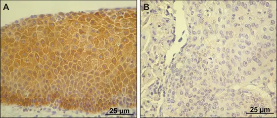 A) Normales Gebärmutterhalsgewebe, das viel pro-IL-1β enthält (braun gefärbt) B) Gebärmutterhalskrebs, negativ für pro-IL-1β
