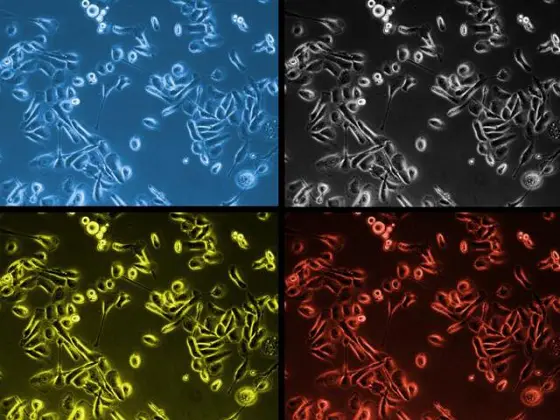 Prostate cancer cells under the microscope.