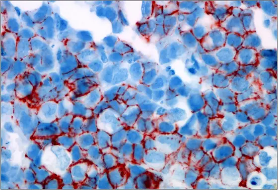 Circulating tumor cells isolated from the blood of breast cancer patients form a metastatic tumor in the bone marrow of mice. The stem cell marker CD44 is dyed red.