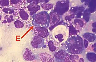 Dysplastische MDS-Zellen aus dem Knochenmark einer transplantierten Maus.