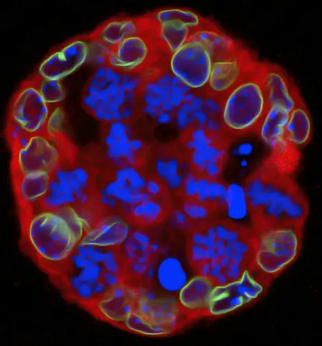 In den Brustdrüsenzellen sind sowohl das Krebsgen KRAS als auch Mad2, das Chromosomen-Fehlverteilungen auslöst, überaktiviert. Die Zellen wachsen in der Kulturschale zu dreidimensionalen Strukturen heran, so genannten Sphäroiden.