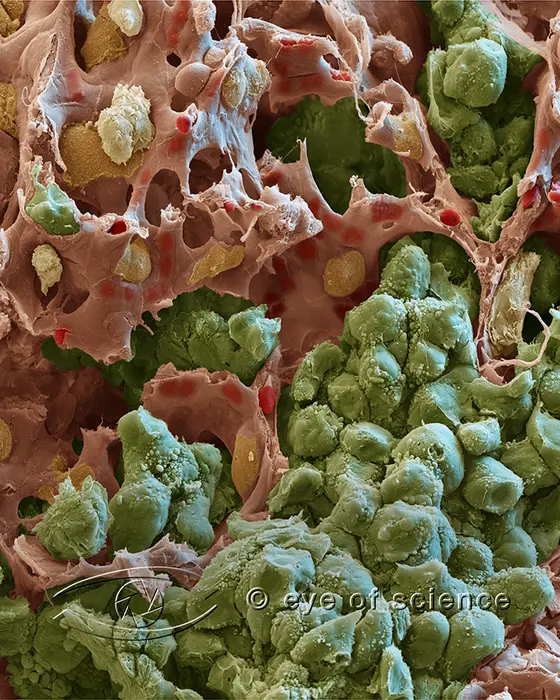 Scanning electron microscopic image of a lung metastasis: Tumor cells (green) may form solid nodules in close contact to nearby capillaries (red). The bi-directional crosstalk between tumor cells and endothelial cells enables the growth of metastases. Recent discoveries suggest a much more active role of endothelial cells during this process than has previously been anticipated.