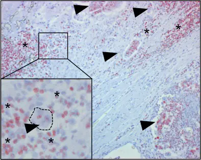 HMGB1 positive (red color indication) immune cells infiltrate a colon carcinoma.