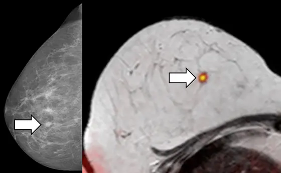 Suspicious lesion detected in the X-ray screening mammogram (left image). The lesion is confirmed using the combined diffusion weighted breast MR technique with the orange signal suggesting possible malignancy. Histopathology confirmed a malignant breast tumor.