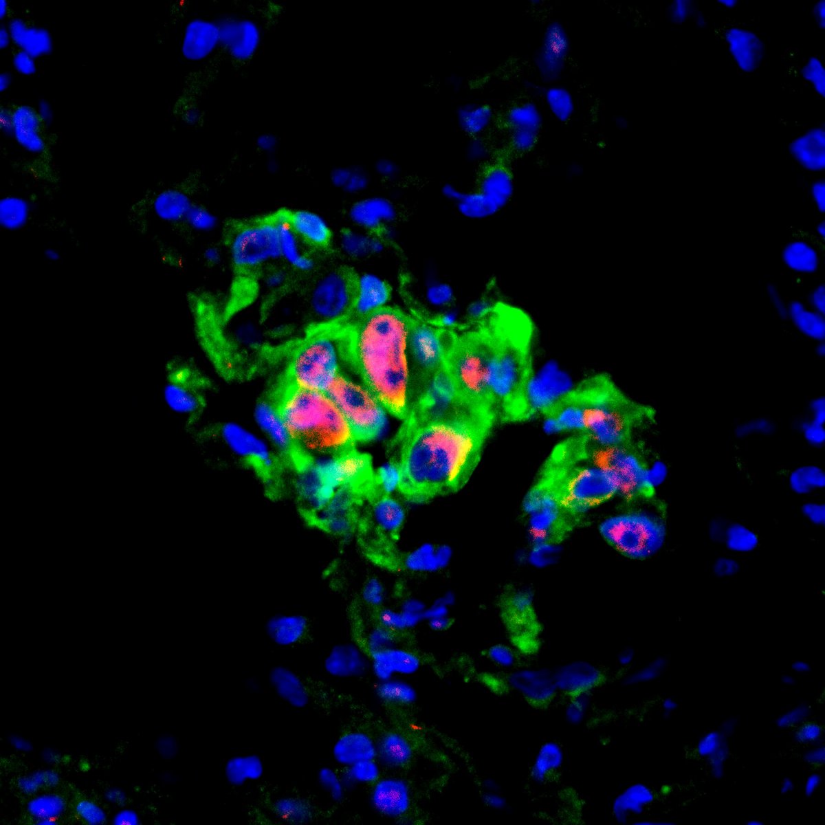 Breast cancer: Stress signaling promotes metastasis and therapy ...