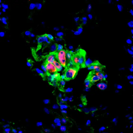 Lungenkrebs-Mikrometastase in der Maus: In den rot markierten Zellen ist der zentrale Stress-Schalter JNK aktiv. Krebszellen sind grün, Zellkerne blau gefärbt.