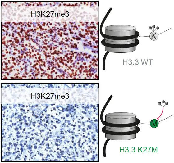 Ergebnisse des Immuntests IHC für H3K27me3 in einem Tumor ohne K27M Mutation (oben: viel braune Färbung zeigt viel Methylierung) und einem Tumor mit K27M Mutation (unten: wenig braune Färbung bedeutet wenig Methylierung). Das rechte Schema zeigt, dass Lysin (oben) methyliert ist, Methionin in der Mutante unten aber nicht methyliert werden kann.
