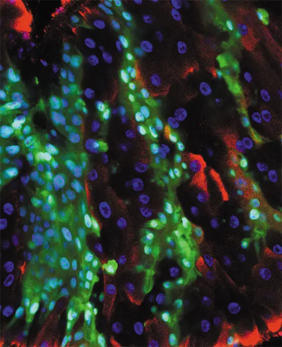 Intestinal tumors cells (green) in Drosophila. Red: dying cells.