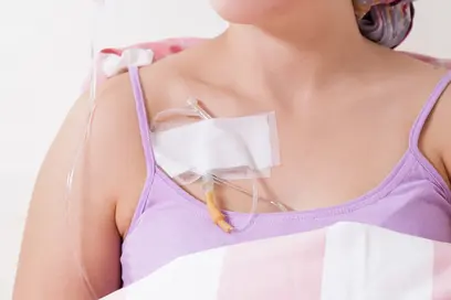 Eine Person mit einem medizinischen Zugang auf der Brust trägt ein lila Oberteil und ist mit einer Decke zugedeckt. Sie scheint sich in einer medizinischen Umgebung zu befinden und ist möglicherweise in Behandlung. Ihre Gedanken scheinen nachdenklich oder ernst zu sein.