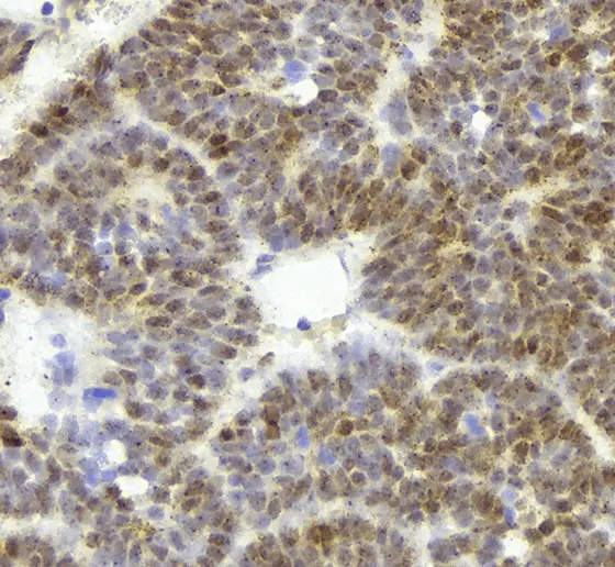 Nachweis von DNA-RNA-Strukturen („R-Loops“) in einer ETMR-Gewebeprobe.