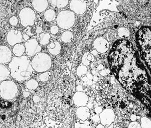 Electron microscopy image of dying brain tumor cells: Giant mitochondria appear as white circles - Wilfried Roth, DKFZ