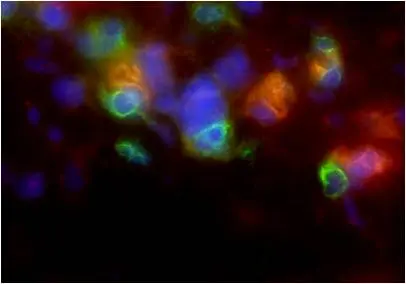 T-Zellen (grün) attackieren mit Hilfe von TNF-alpha (rot/orange) Tumorzellen (grosse blaue Zellen)