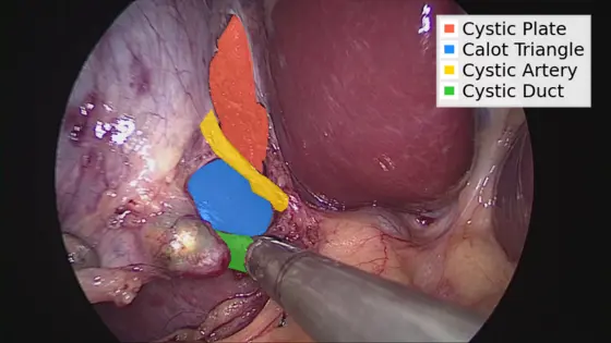 Das Bild zeigt eine chirurgische Ansicht des Gallenbereichs, mit verschiedenen anatomischen Strukturen farblich markiert: die cystische Platte, das Calot-Dreieck, die cystische Arterie und den cystischen Gang. Diese Bezeichnungen helfen, die relevanten Bereiche während eines chirurgischen Eingriffs zu identifizieren.