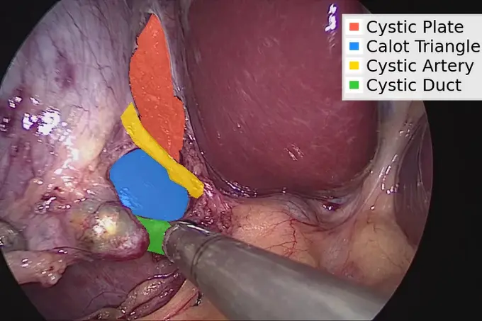Das Bild zeigt eine chirurgische Ansicht des Gallenbereichs, mit verschiedenen anatomischen Strukturen farblich markiert: die cystische Platte, das Calot-Dreieck, die cystische Arterie und den cystischen Gang. Diese Bezeichnungen helfen, die relevanten Bereiche während eines chirurgischen Eingriffs zu identifizieren.