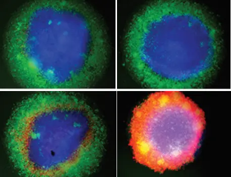 Fluroeszenzmikroskopie von Brustkrebs-Organoiden: Krebszellen fluoreszieren blau, T-Zellen grün: Nur wenn Brücken- und Verstärkerantikörper am Organoid zusammenwirken, ist eine erhebliche Aktivierung der T-Zellen zu beobachten. Die T-Zellen wandern in das Organoid ein und die Krebszellen sterben weitgehend ab (rot).