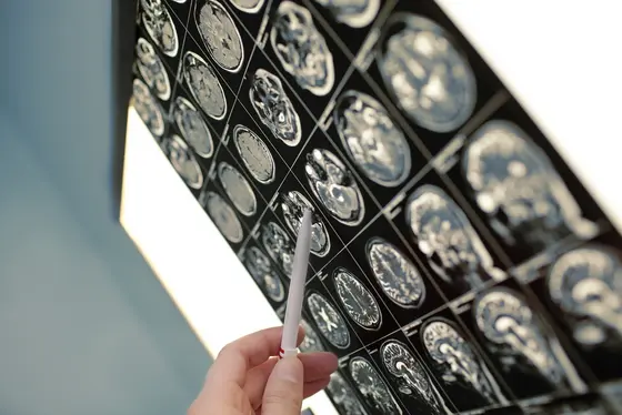 Bei etwa drei bis fünf Prozent aller Krebserkrankungen finden die Ärzte Metastasen, können aber trotz aufwändiger Diagnostik nicht den Primärtumor identifizieren.