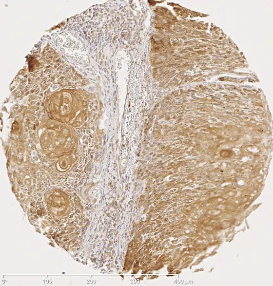 Gewebeschnitt eines Plattenepithelkarzinoms. Die braune Färbung weist eines der fünf Proteine nach, deren Gene bei Tumoren mit günstigem Verlauf unterschiedlich methyliert sind.