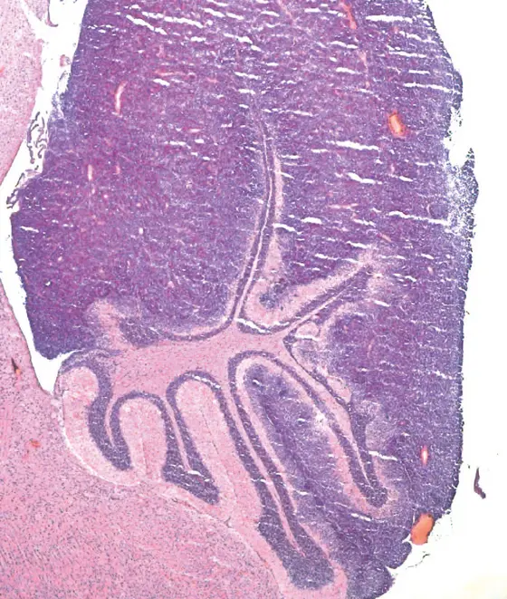 Wird das Tumorsuppressor-Gen Ptch1 mit der CRISPR/Cas9-Technik ausgeschaltet, entwickeln Mäuse ein Medulloblastom
