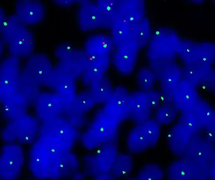 Fluoreszenz-Aufnahme von Zellen eines Hochrisiko-Hirntumors (Ependymom): Den Verlust von Erbmaterial erkennt der Wissenschaftler an den nur einfach vorhandenen roten bzw. grünen Punkten. In einer gesunden Zelle würde man zwei Signale jeder Farbe (= 2 Kopien jeder spezifischen DNA) erwarten.