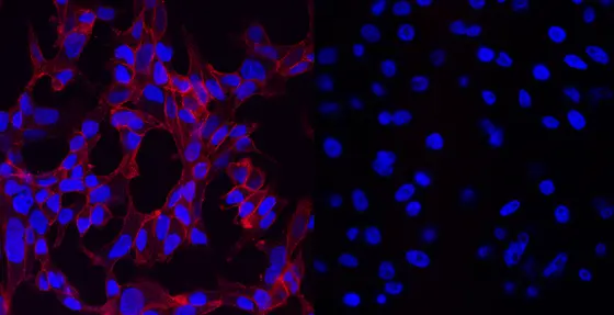 Das bimodale Radiopharmakon erzeugt einen in der Fluoreszenzmikroskopie erkennbaren Kontrast zwischen PSMA-positiven Tumorzellen (links) und PSMA-negativen Zellen (rechts). Dadurch lässt sich bei der Operation bösartiges Gewebe besser erkennen.