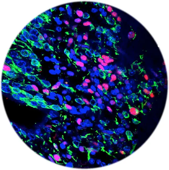 Brain tumor stem cells labeled with green fluorescent protein are mostly negative for cell proliferation marker PCNA (red).