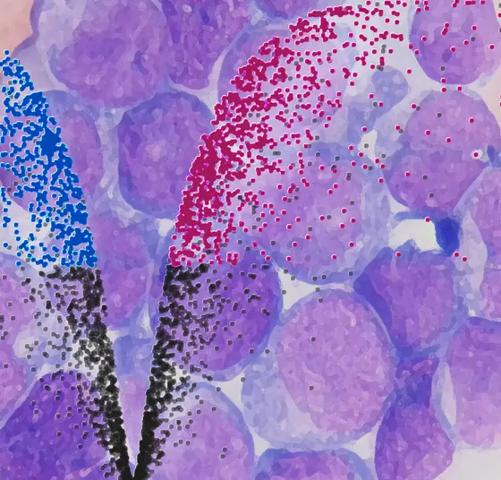 Krebsstammzellen mit einem charakteristischen Proteinexpressionsprofil lösen Blutkrebs aus.