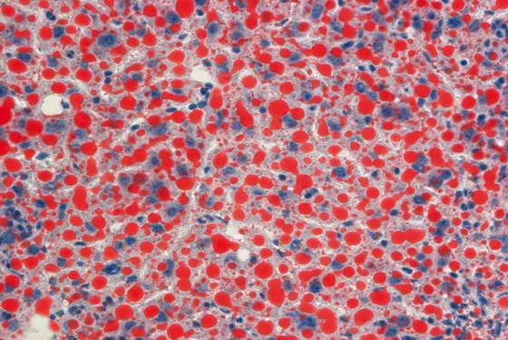 Fettansammlung in der Leber tumortragender Mäuse