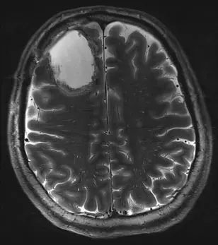 Magnetresonanz-Aufnahme nach der operativen Entfernung eines Hirntumors