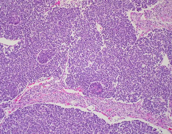 Wilm's Tumor (Nephroblastoma)
