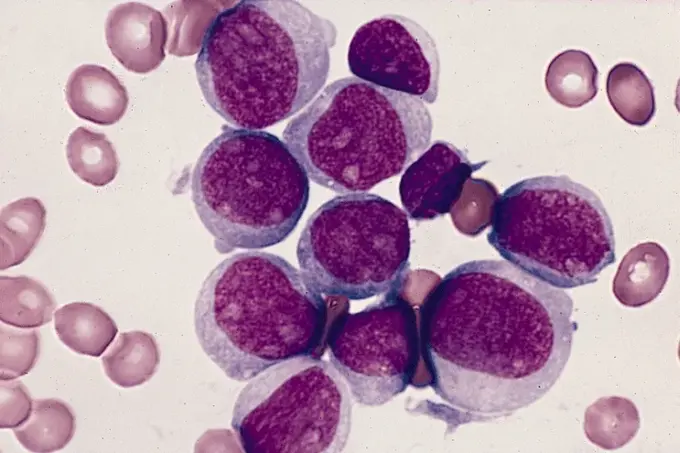 Mikroskopische Aufnahme von Myeloblasten bei akuter myeloischer Leukämie.