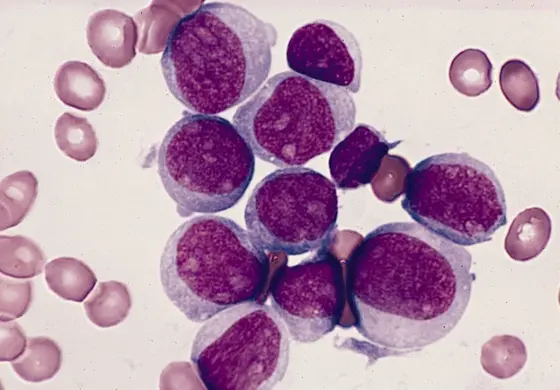 Mikroskopische Aufnahme von Myeloblasten bei akuter myeloischer Leukämie.