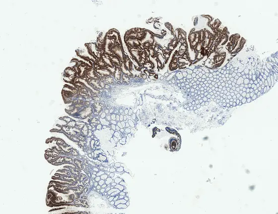 Das Bild zeigt einen entarteten menschlichen Darmpolypen mit immunohistochemischer Anfärbung des Biomarkers DIA2 zur Erkennung früher Darmkrebsstadien (Adenoma) und das angrenzende gesunde Gewebe.