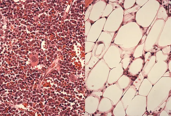 After waking up the hematopoietic stem cells, bone marrow of normal mice (left) is packed with blood cells whereas the bone marrow of Fanconi mice is severely depleted, the blood cells have been replaced by fat cells.