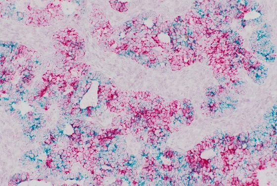 Mikroskopische Aufnahme von Gewebe mit einer Mischung aus rosa und blauen Farbtönen. Die Struktur zeigt unregelmäßige, verzweigte Formationen, die an Zellen oder Gewebereste erinnern. Die Farben deuten auf verschiedene Bestandteile oder chemische Reaktionen im Gewebe hin.