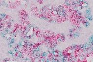 Mikroskopische Aufnahme von Gewebe mit einer Mischung aus rosa und blauen Farbtönen. Die Struktur zeigt unregelmäßige, verzweigte Formationen, die an Zellen oder Gewebereste erinnern. Die Farben deuten auf verschiedene Bestandteile oder chemische Reaktionen im Gewebe hin.